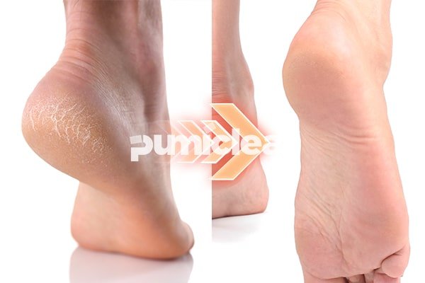 Callus removal comparison