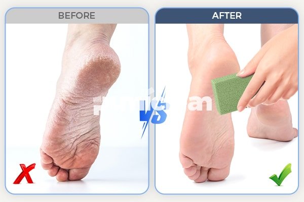 Before-after comparison: foot with dry callus before, then after using custom logo disposable foot care pumice stone, visible improvement